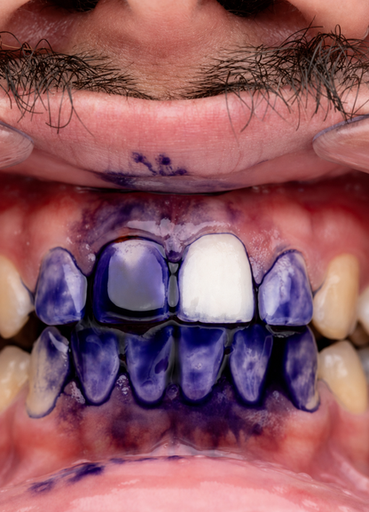 PURPLE V34 - Blanqueador Dental